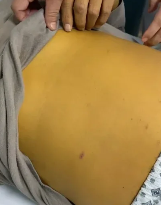 间接胆红素18μmol/l严重吗?