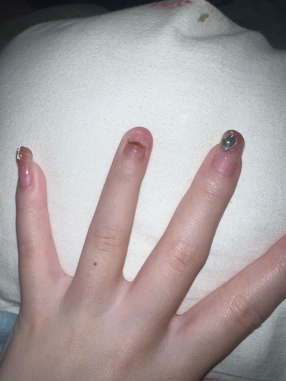 记录一下美甲拔甲后到恢复全过程 图一 12月做完美甲后美甲翻了去医院