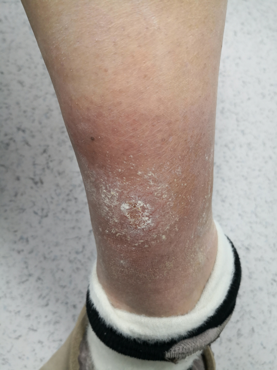 接触性皮炎患者恢复期.#过敏##接触性皮炎