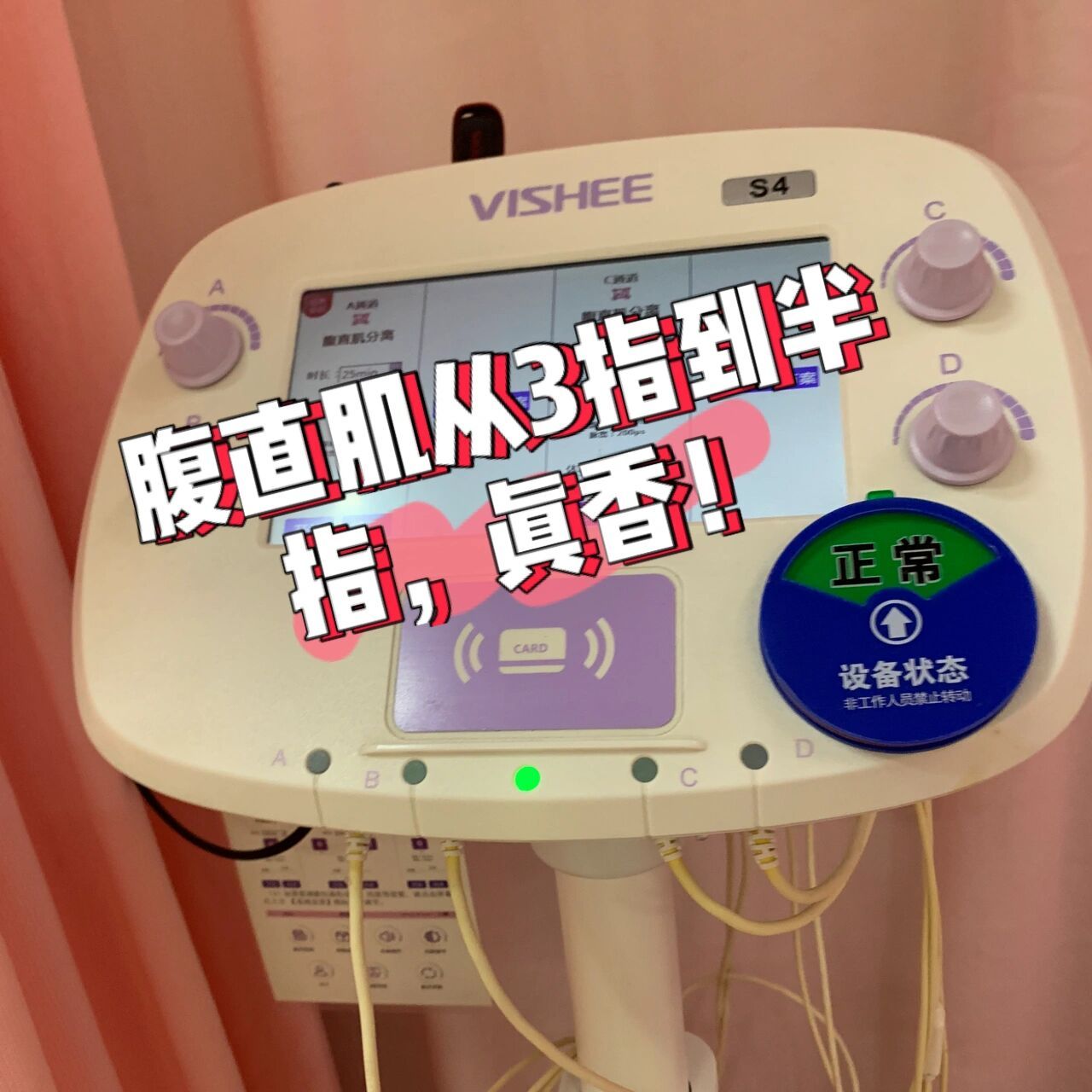 好在医院的腹直肌修复效果实在太好了,做了8次电疗,腹直肌就只剩半