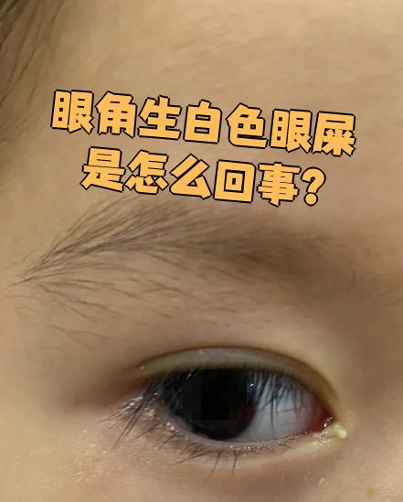 为什么眼睛老是有眼屎