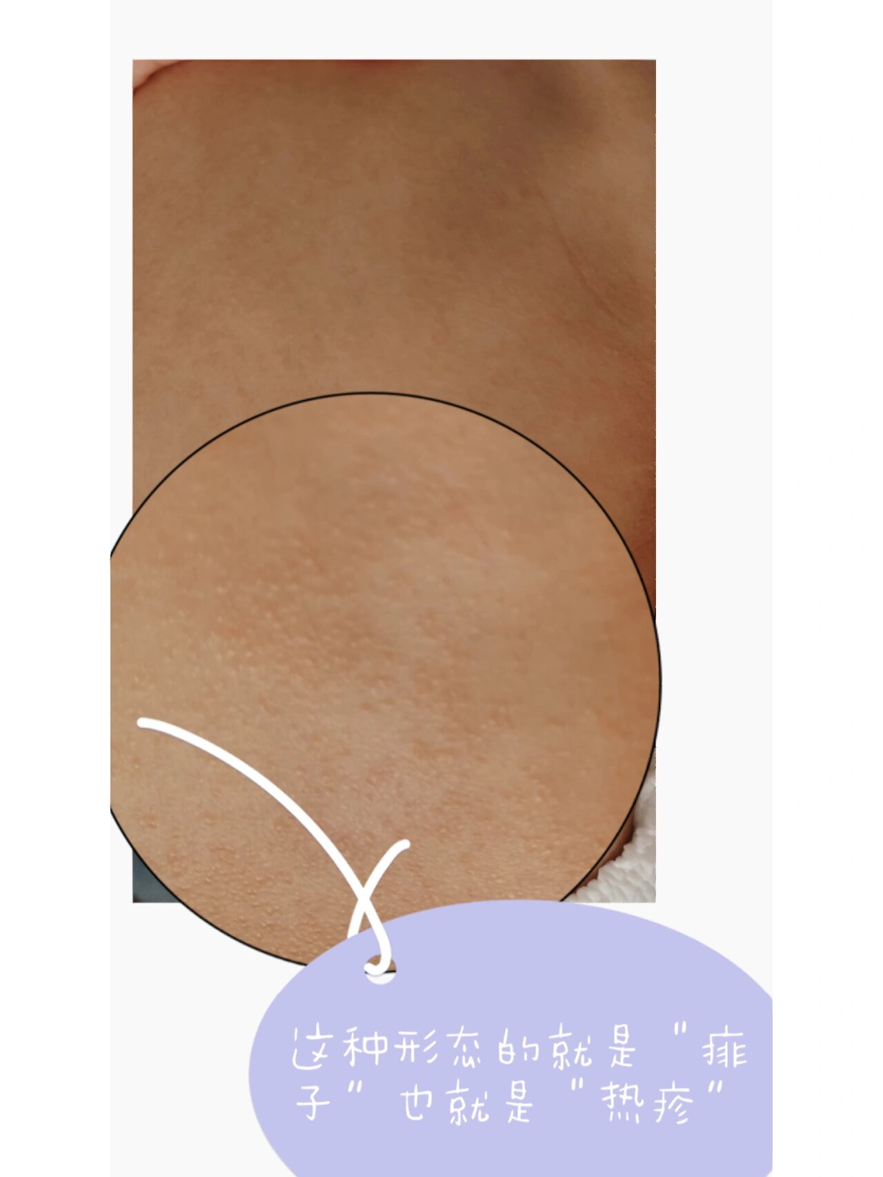 冬天也会长痱子吗?