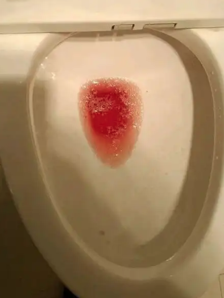 女性小便带血还疼,最常见的原因有三个: