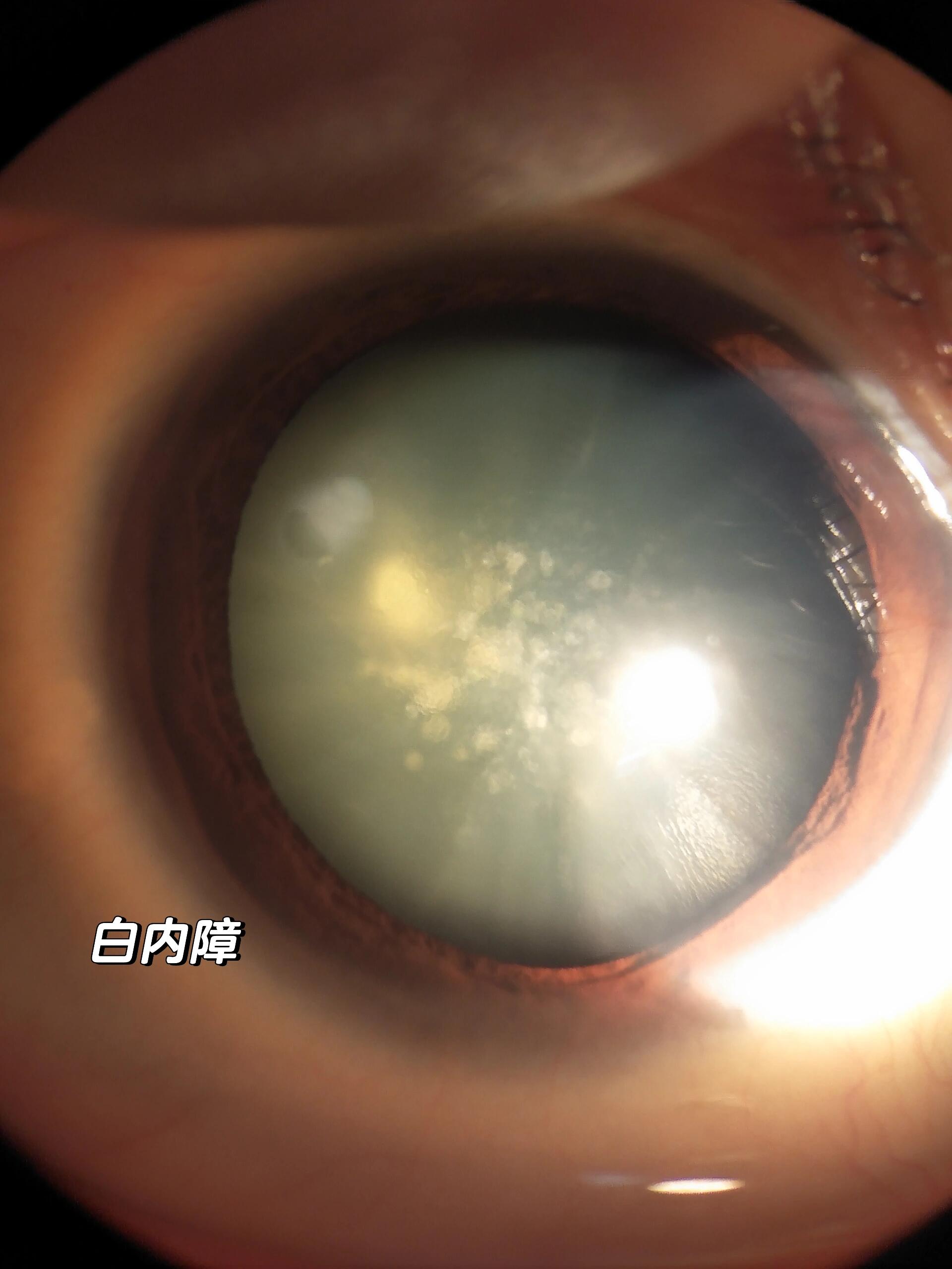 一图认识白内障