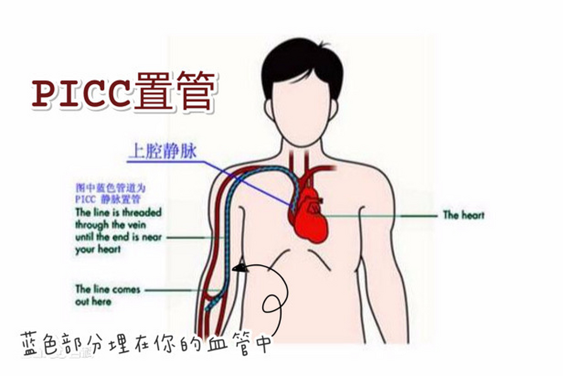 化疗置管示意图图片