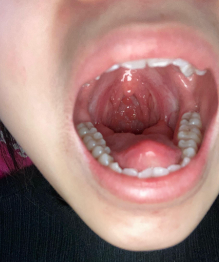 扁桃体是凹凸不平疙瘩状是怎么回事?