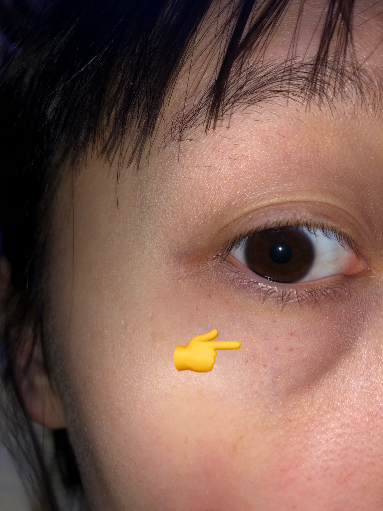 眼下长红点 有谁知道这个是什么吗?