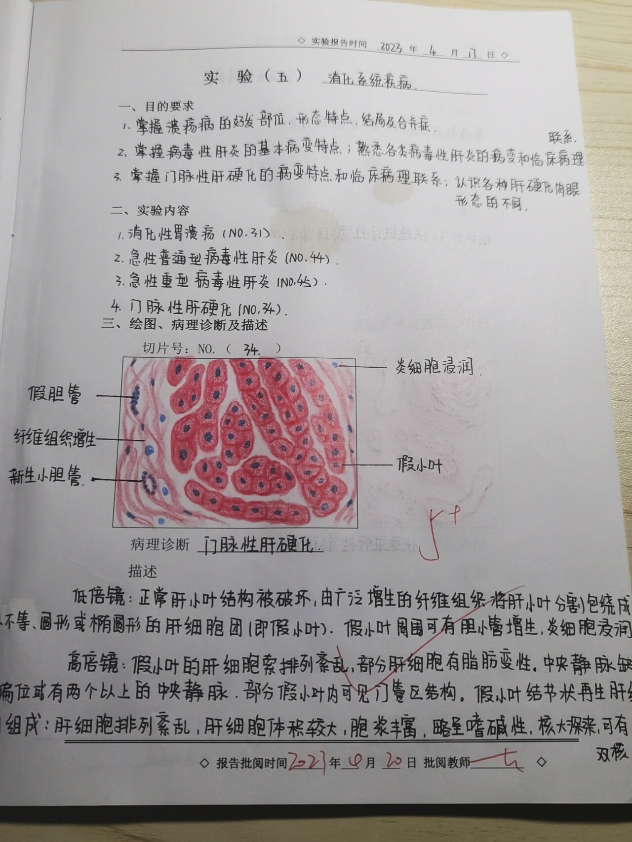 消化系统疾病,门脉性肝硬化