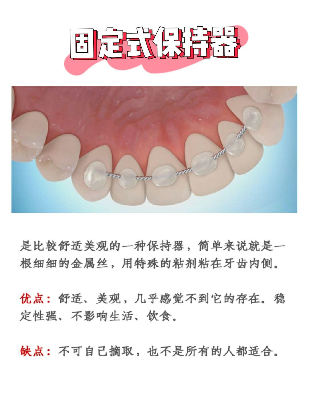 牙齿保持器戴多久图片