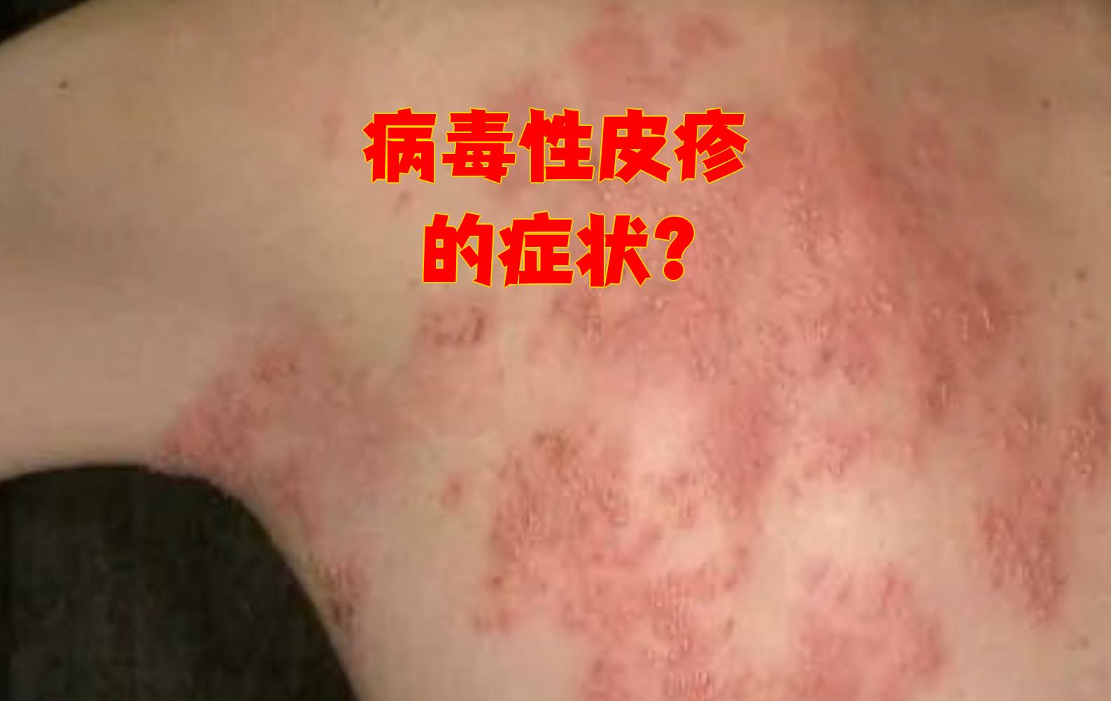  最近的病毒感染有什么症状(各种病毒感染症状)
