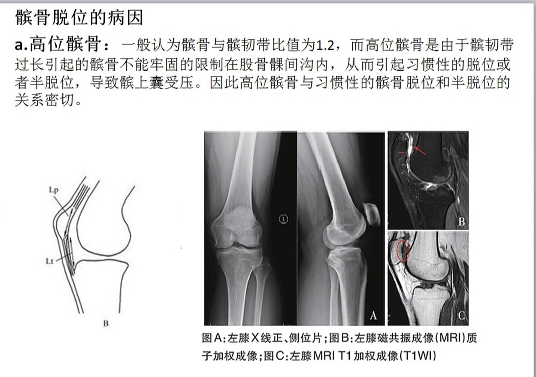 高位髌骨脱位图片