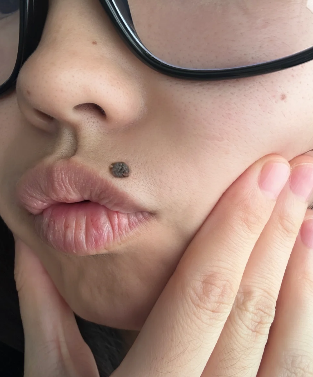 黑色素痣切除手术的费用因人而异,主要和以下几个因素有关