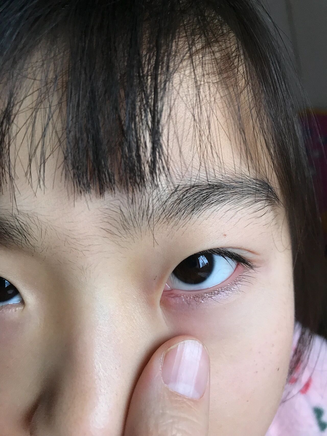 继滤泡结膜炎后,左眼角又起泡了 这又是什么鬼?