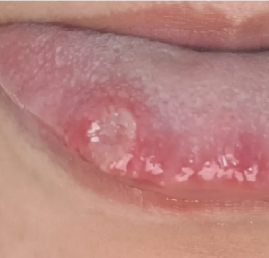 如果是病毒感染,比如疱疹病毒,舌头和口腔黏膜会出现一堆