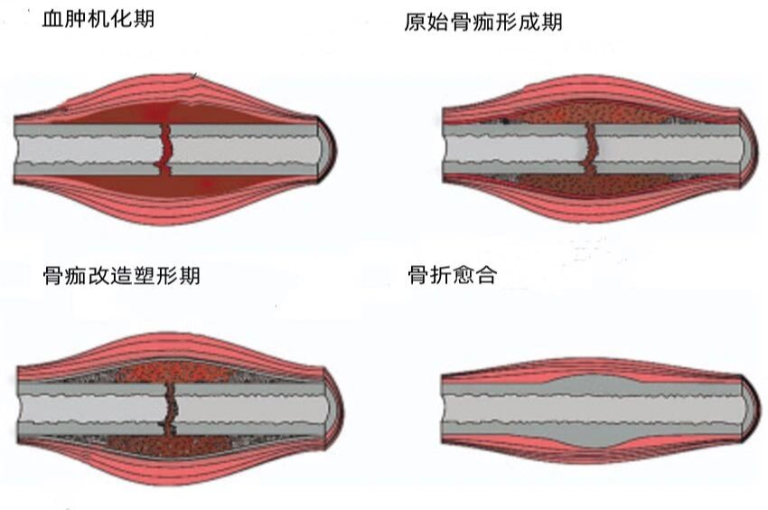 骨折愈合过程图片