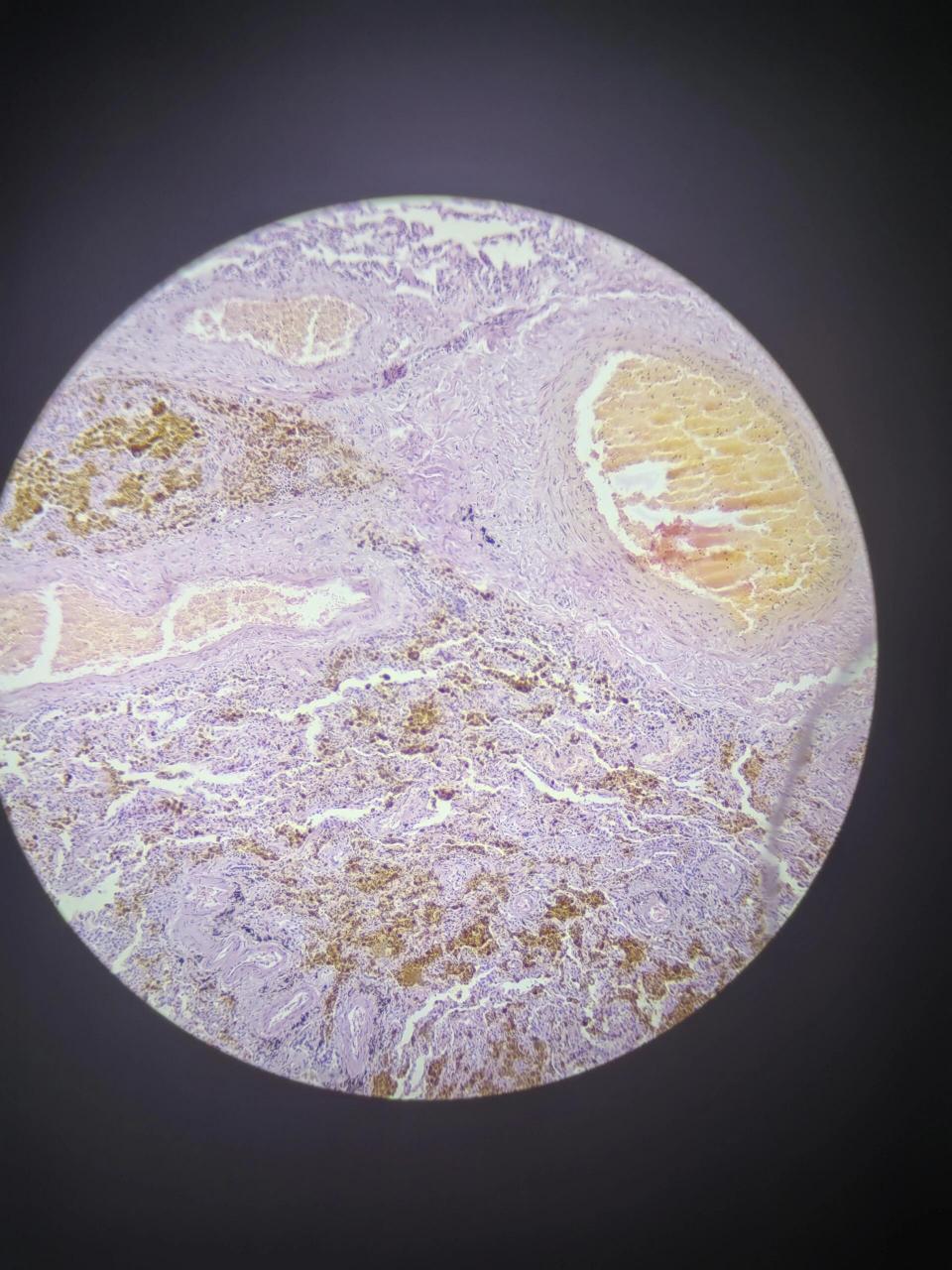 慢性肺淤血 慢性肺淤血 4*0.1 10*0.25 10*40