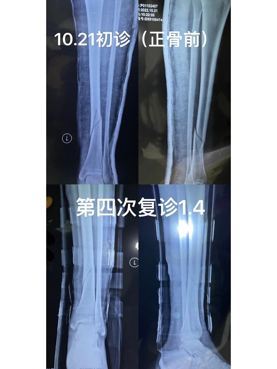 小腿下端胫腓骨骨折75天终于长骨痂了!