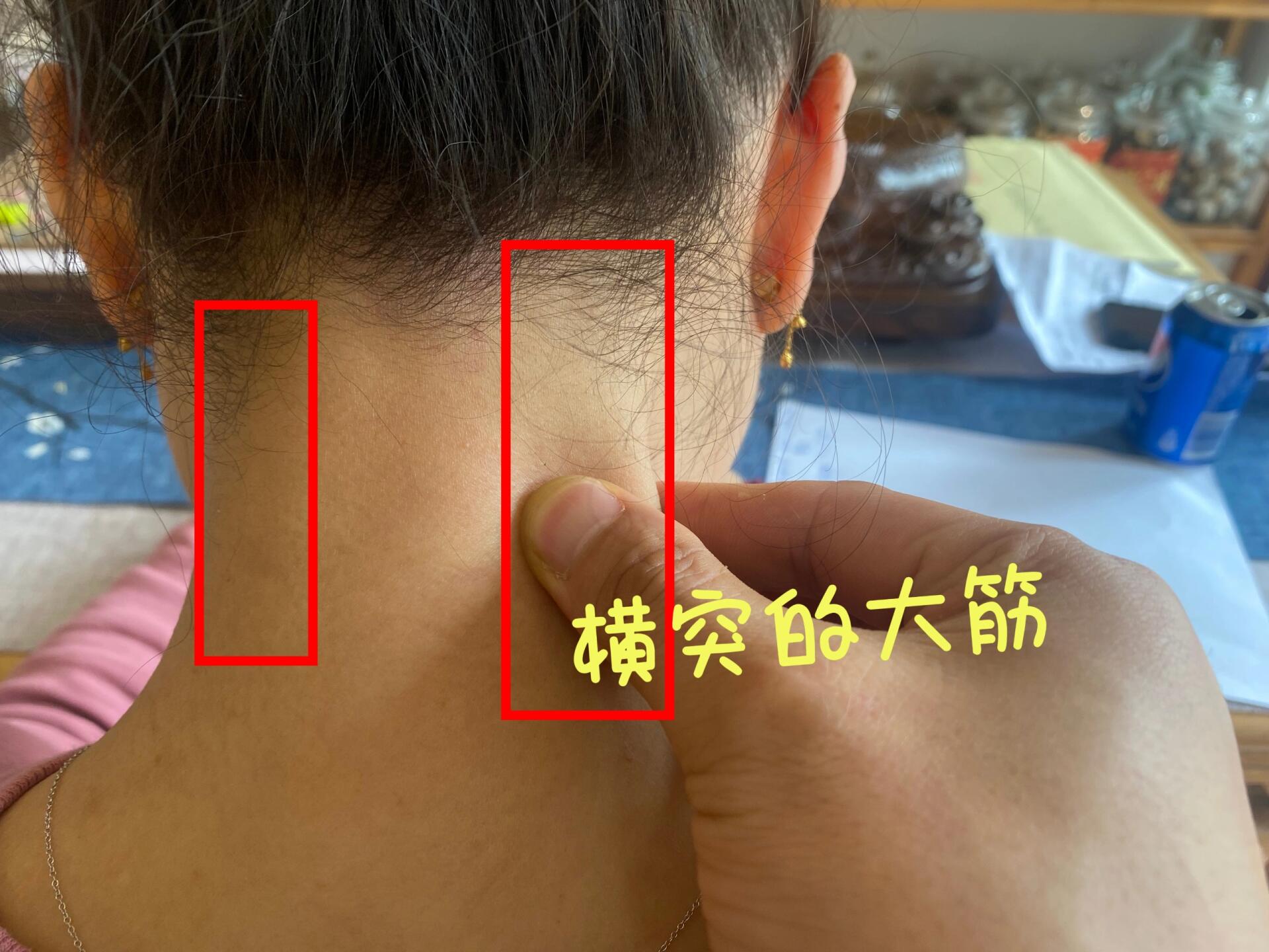 颈椎旋转错位和侧弯错位快速判断