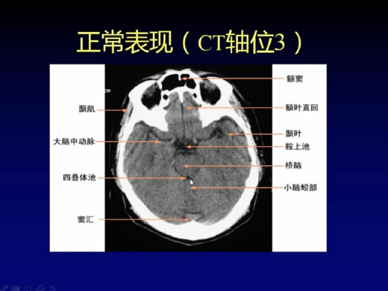 正常脑部ct影像图