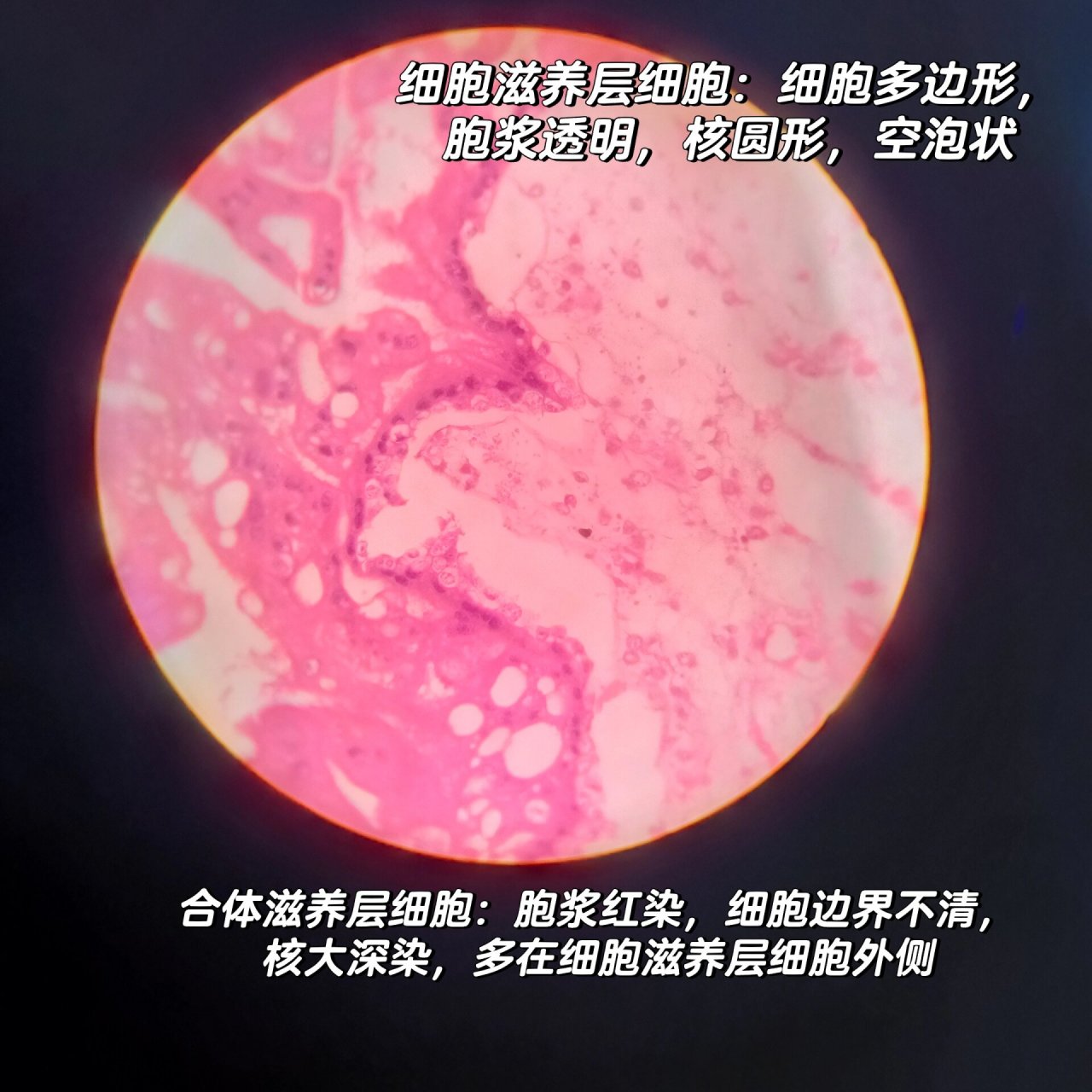 【病理切片复习】葡萄胎(自用) 诊断:葡萄胎 描述:(1)绒毛间质水肿