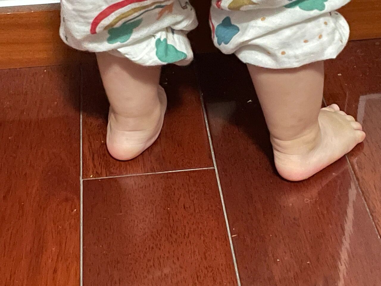 一岁半宝宝足外翻