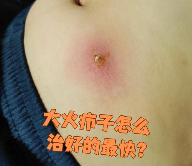 大火疖子,一种由细菌感染引起的皮肤炎症,常让人痛苦不堪