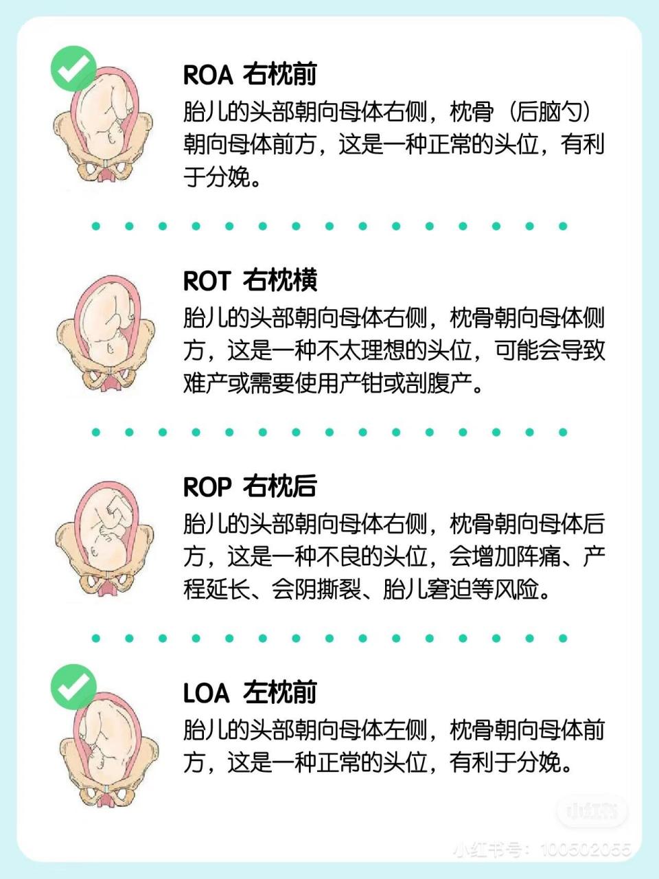 rop胎位 想知道宝宝胎位是rop的宝妈们,最后是怎么把宝宝生下来的.