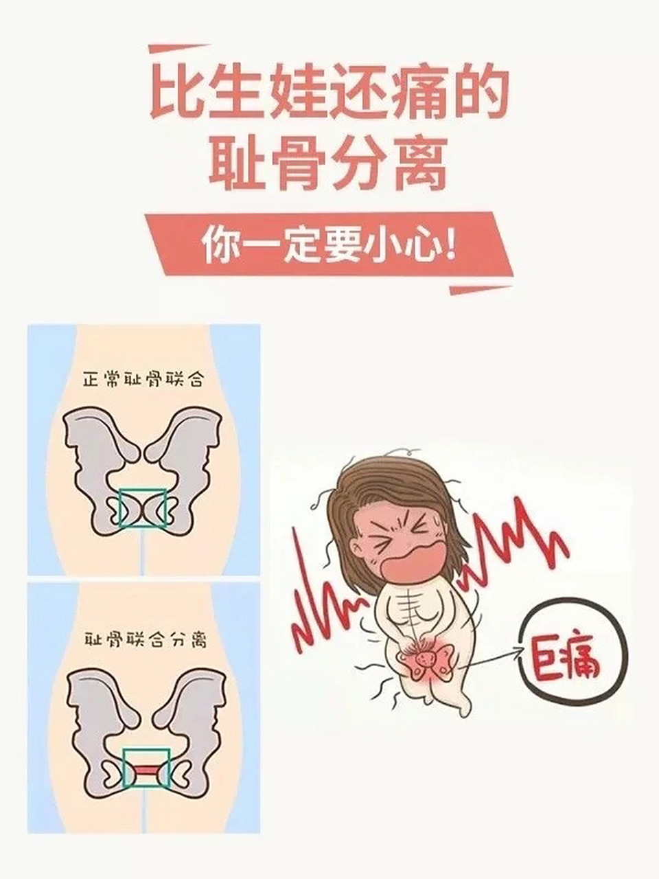 一般是孕中,孕晚期时,耻骨联合部发生的一种疼痛.