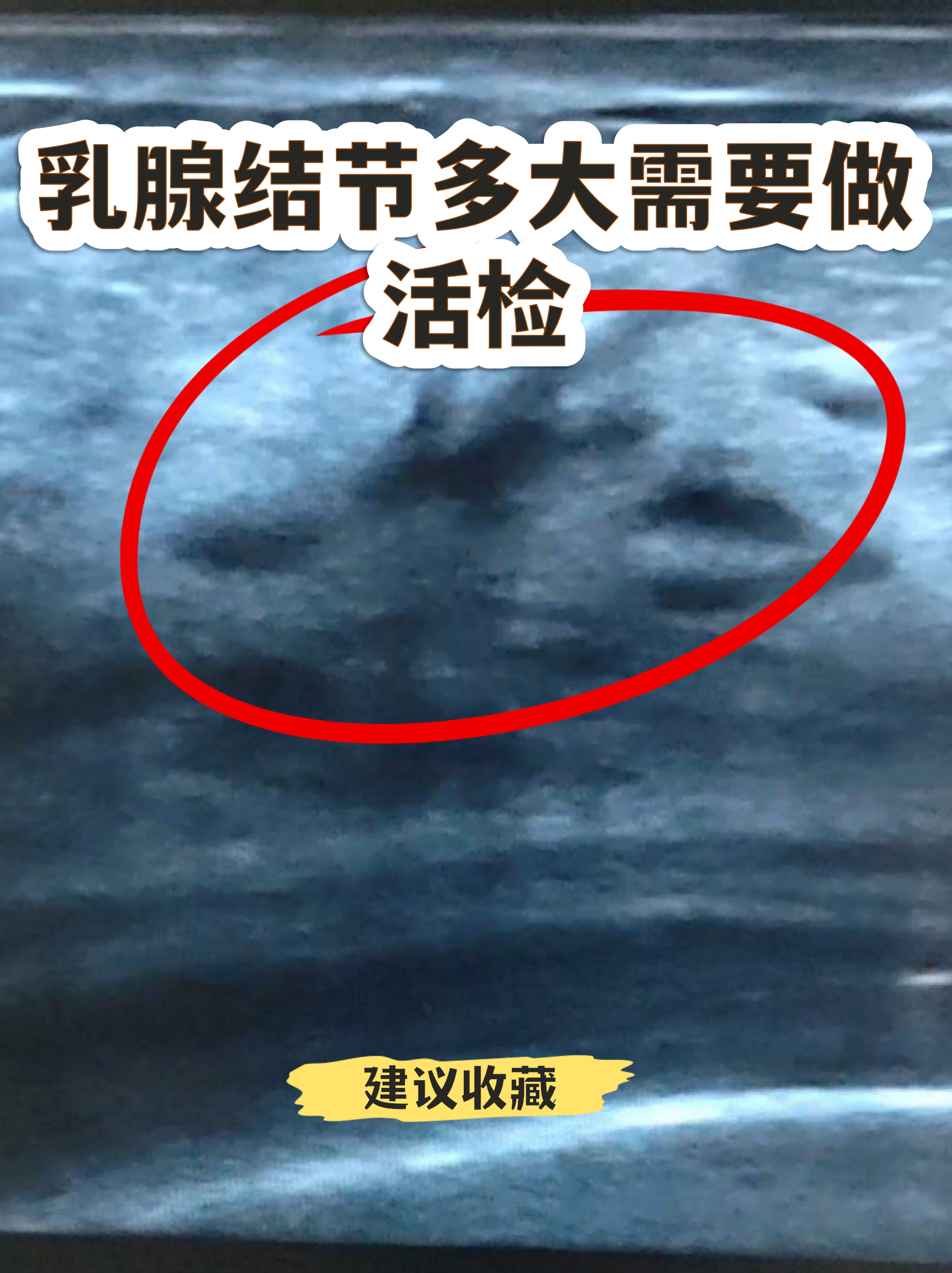 乳腺结节是否需要活检不能只看大小,关键要结合影像学特征和医生乒览