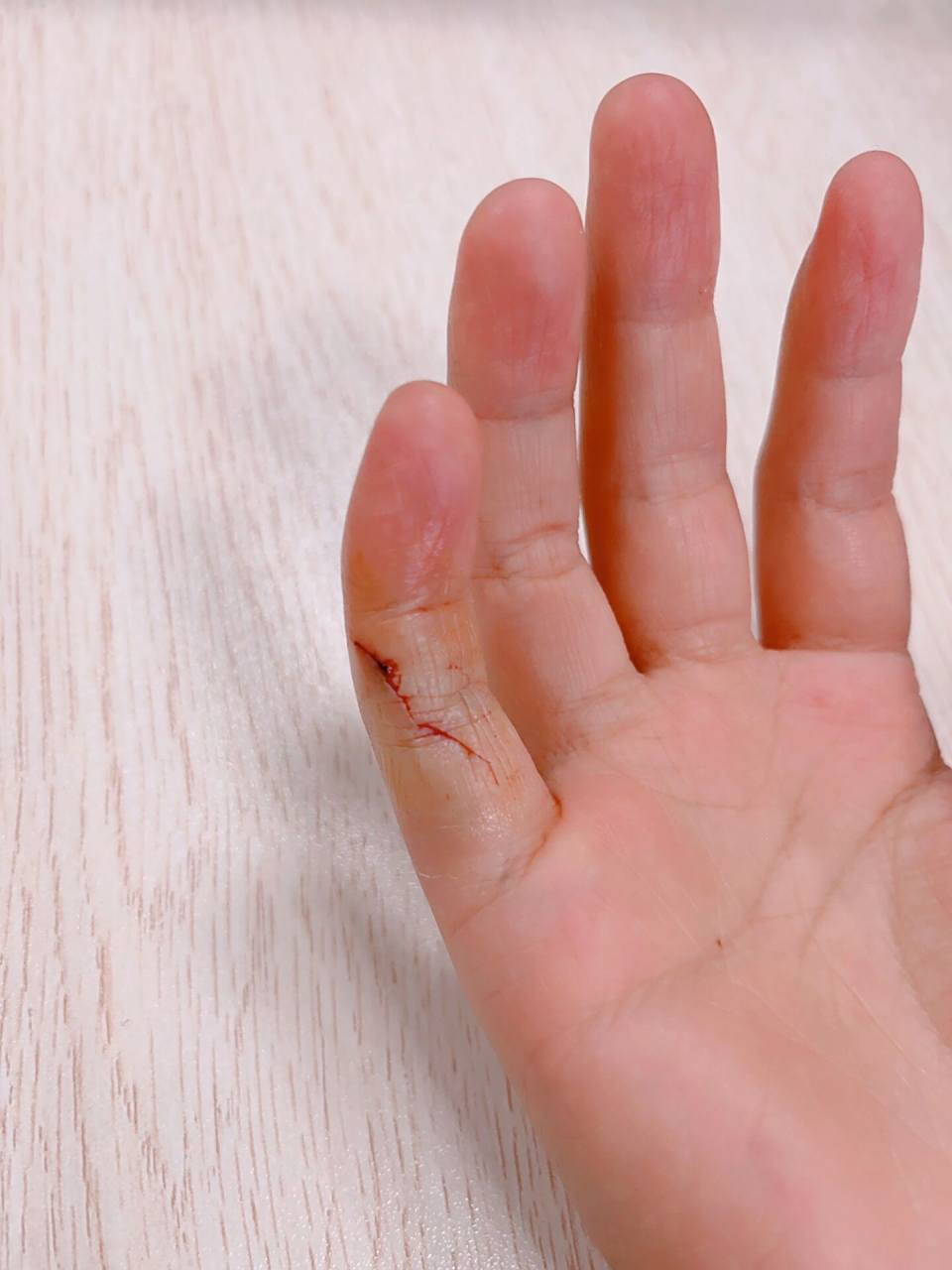 玻璃碗划破手指 真诚发问,被玻璃划破手指是否需要缝合 以前没遇过