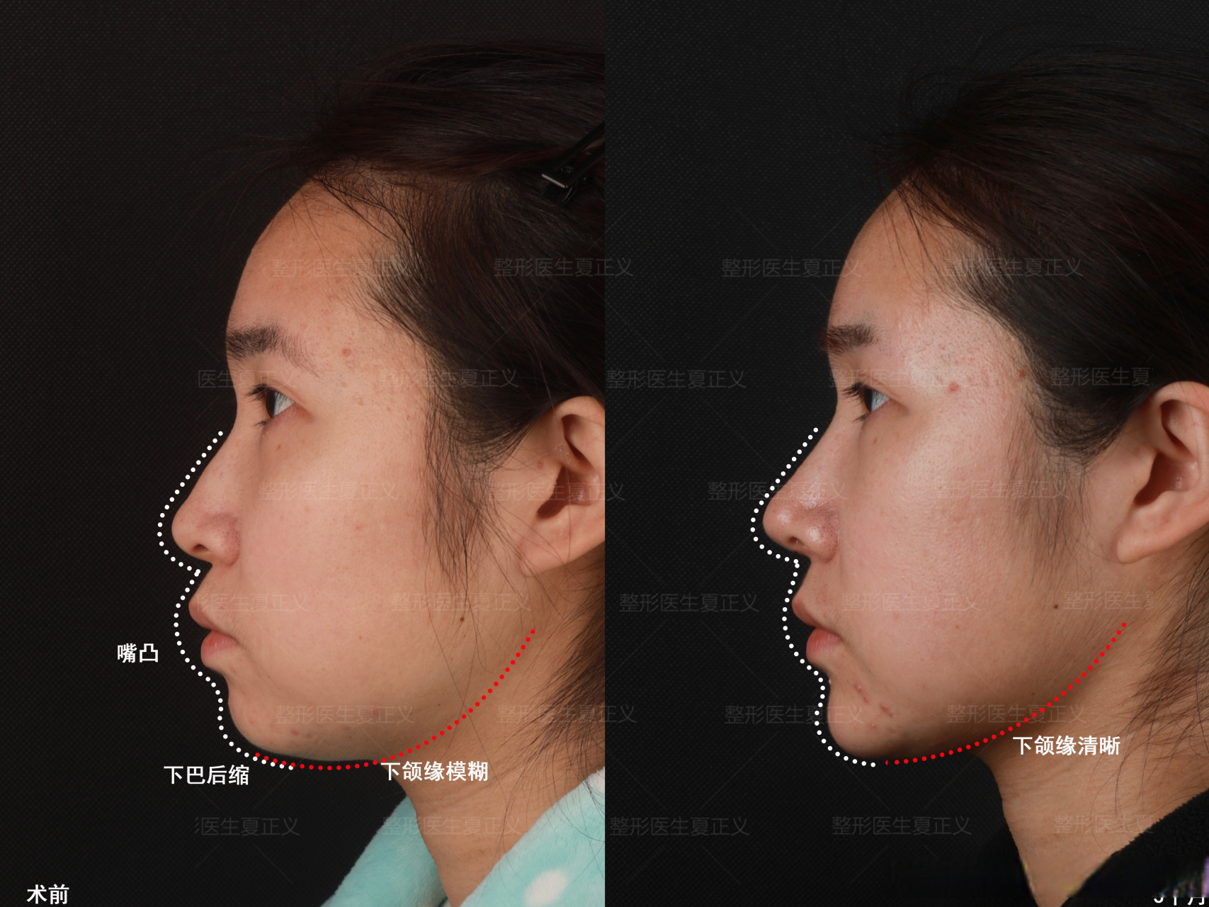 鼻唇角过小,视觉上会显得嘴凸,影响鼻子的挺拔程度; 2.