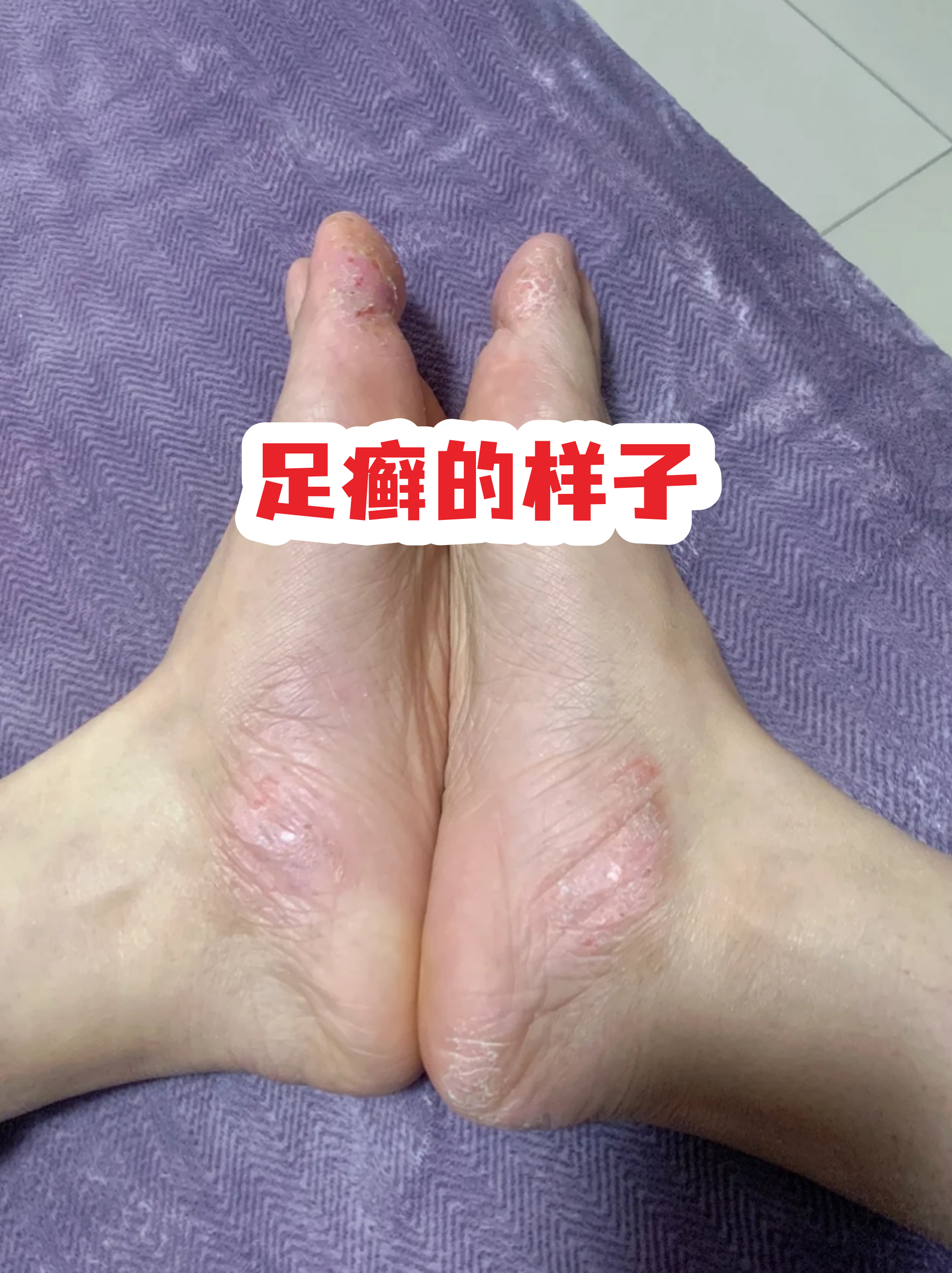 脚上出现脱皮,水疱,瘙痒,甚至裂口,很可能是足癣在作怪