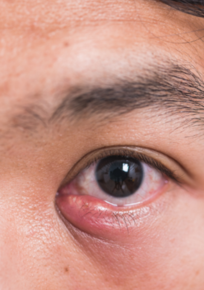 如果是霰粒肿,会在眼皮里摸到一个硬硬的小疙瘩