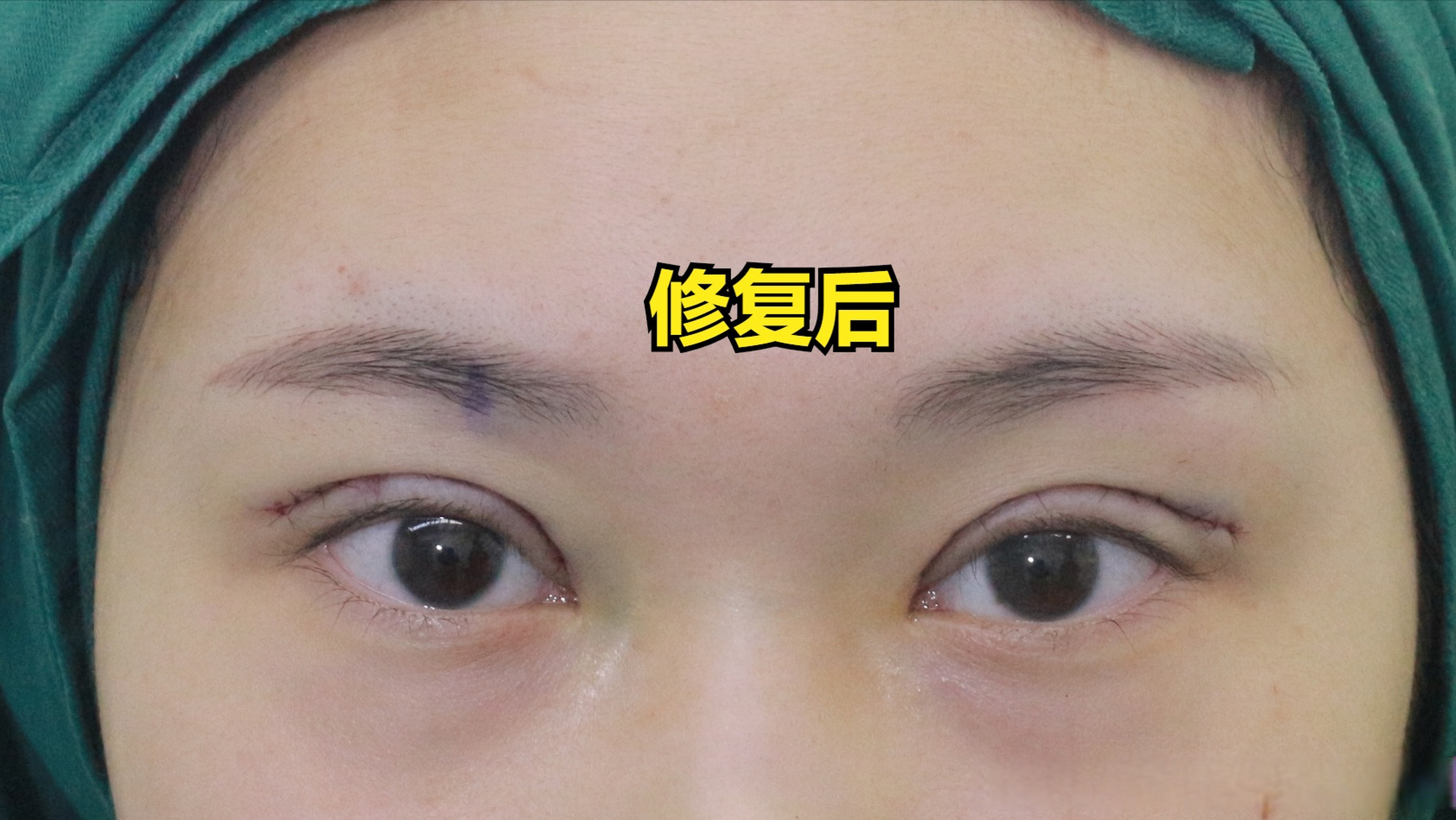 埋线双眼皮术后:双眼皮变浅,多层皱褶,找我们来做了双眼皮修复,2个月