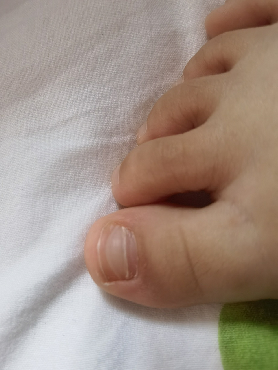 宝宝脚趾甲有横线是怎么回事 今天帮宝宝剪指甲,发现脚趾甲上不知道