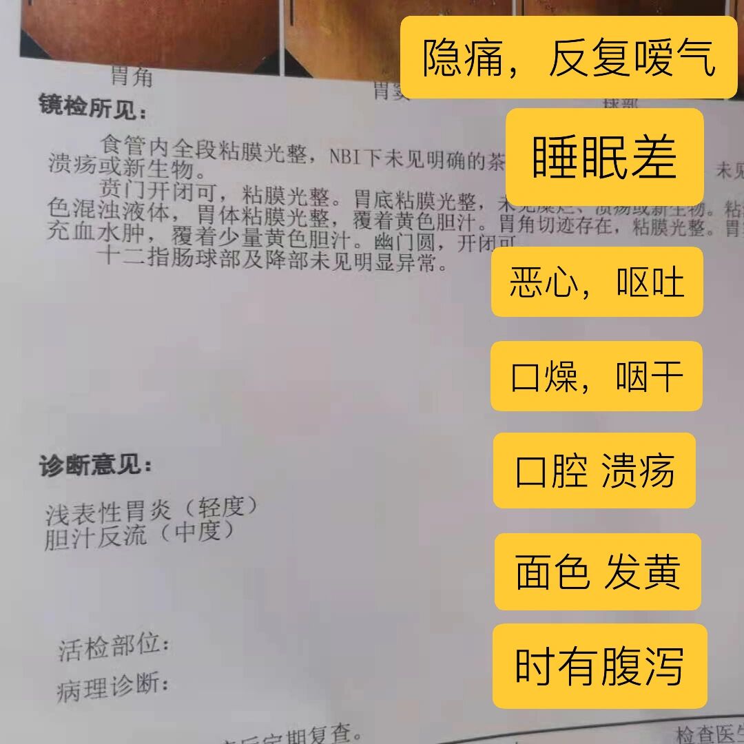 浅表性胃炎(轻度) 胆汁反流(中度) 女,44岁,症状:胃脘隐痛伴反复嗳气