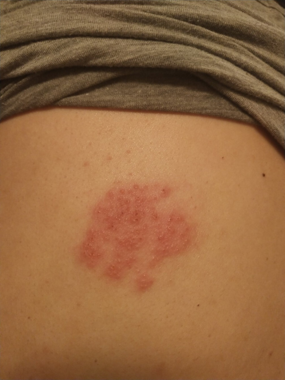 带状疱疹 话说这个病啊,提前看书,听别人说再多,等