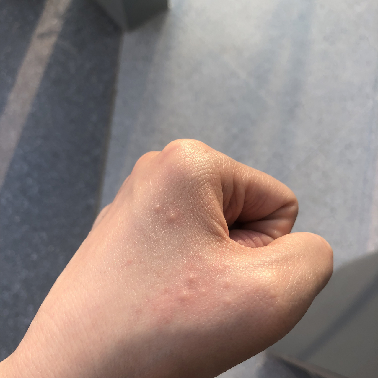 手上长了不知名的小疙瘩 冬天才会长,热了会变大会痒,冷了又会褪下去.