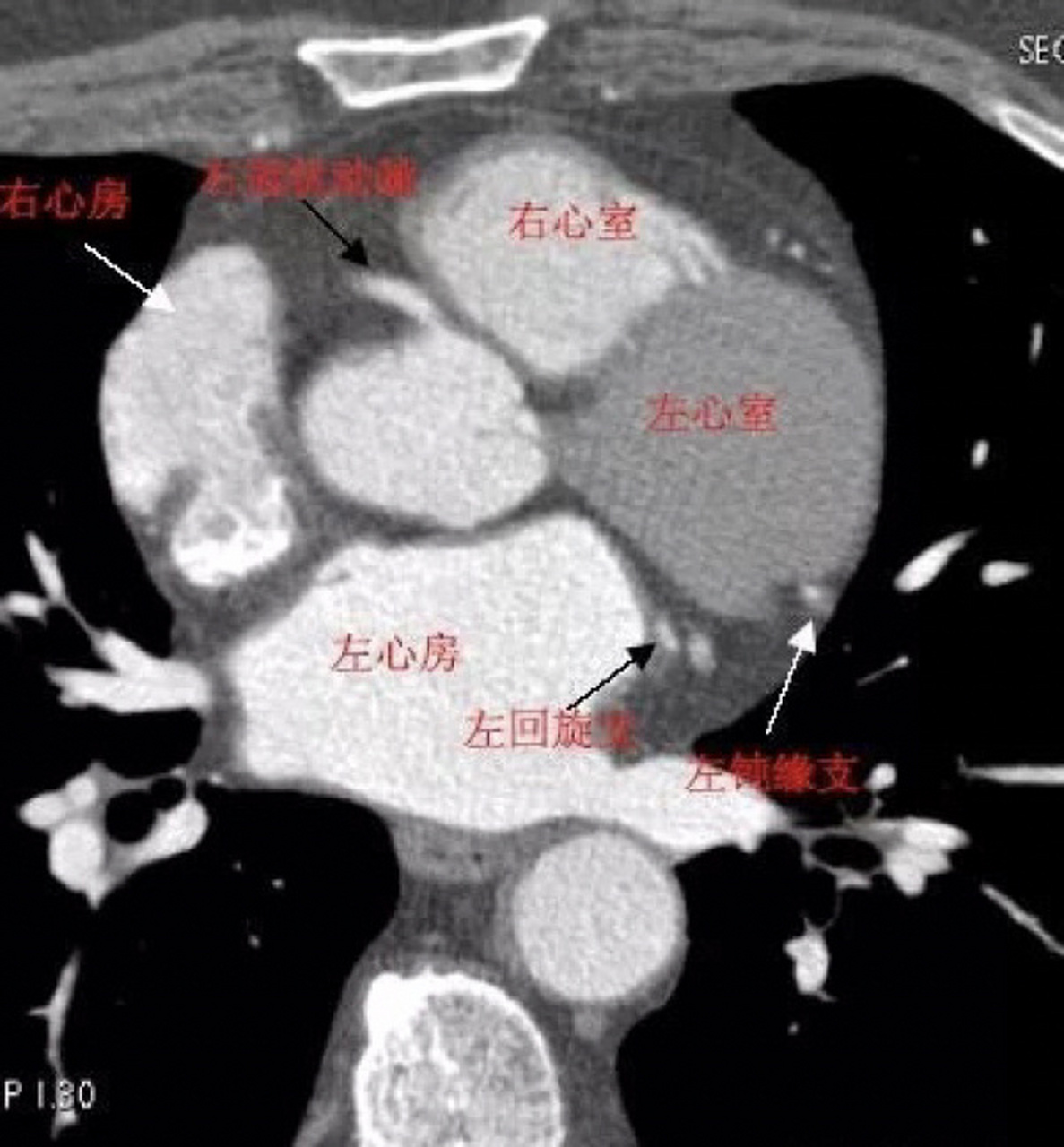 冠状动脉ct片子图片图片