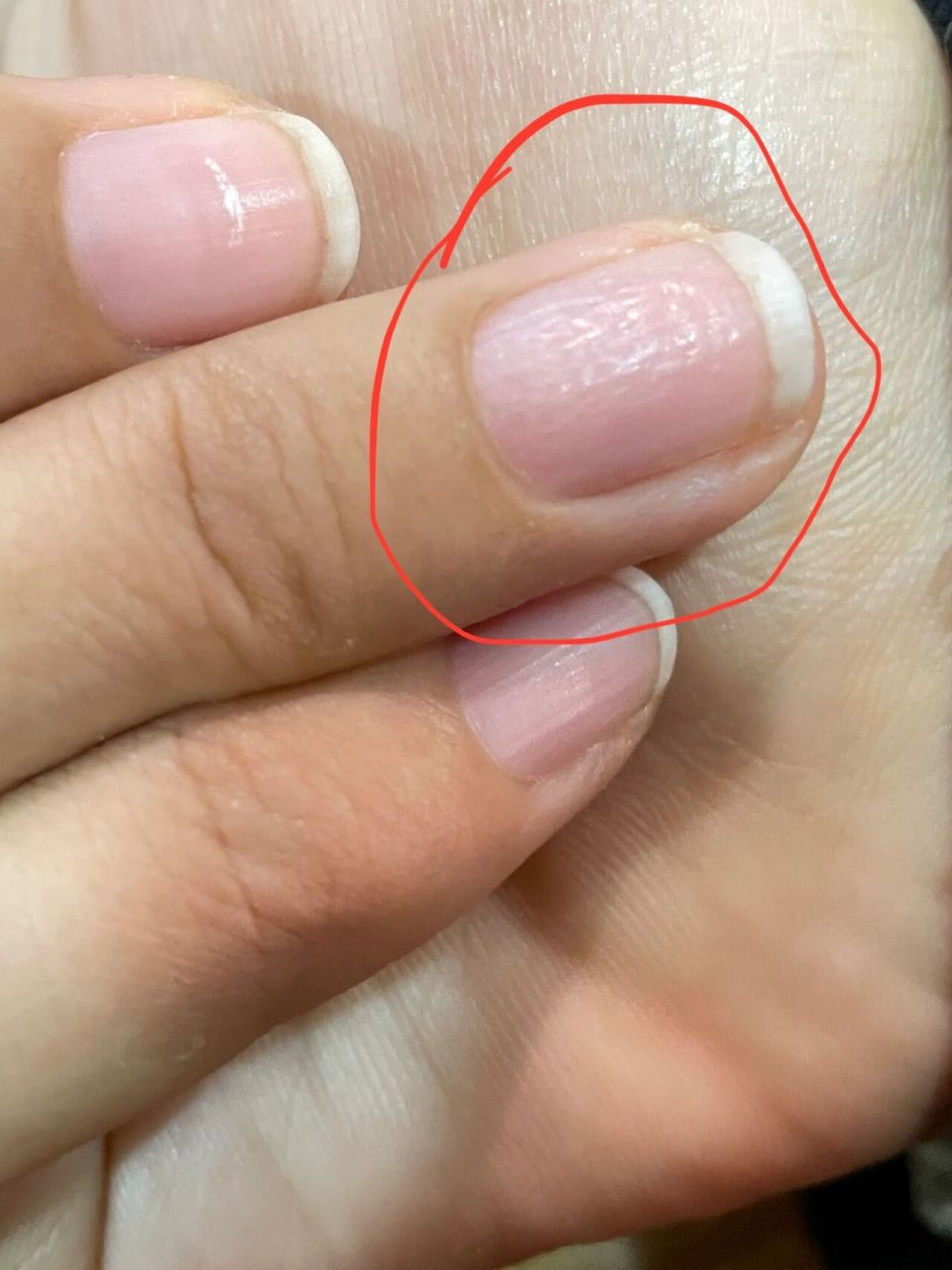 为什么指甲会有小坑,指甲坑坑洼洼的   就这一个指甲这样,不平整,全是