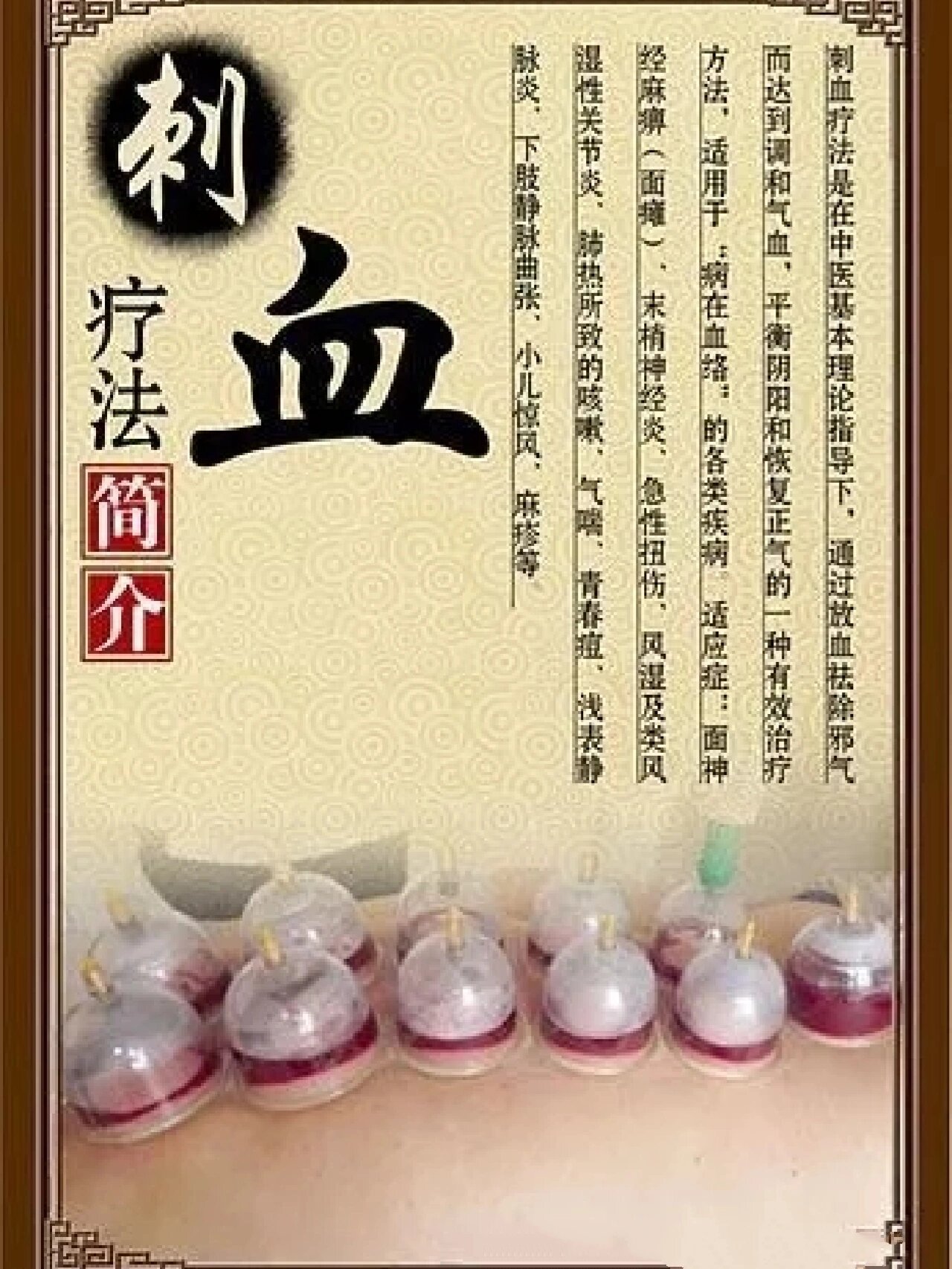 王秀珍(1923年—2000年)现代刺血流派的代表人物,原籍山东,扎根发展