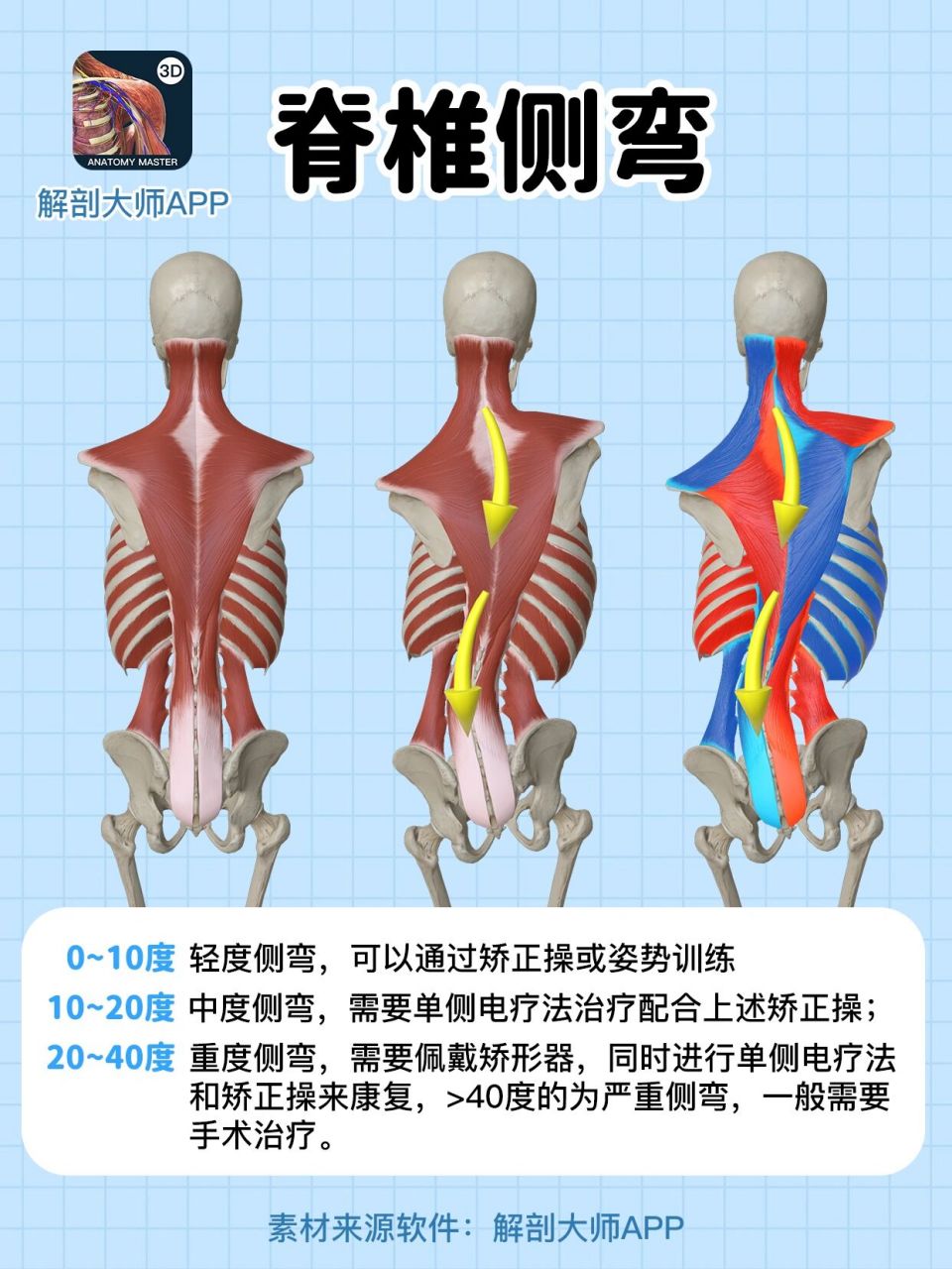 长短腿?如何通过运动调整脊柱侧弯?
