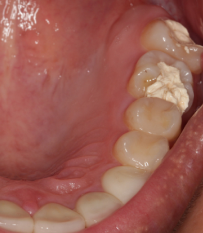 如果牙齿破了一半是因为龋齿,但没伤到牙神经,只是牙釉质或牙本质