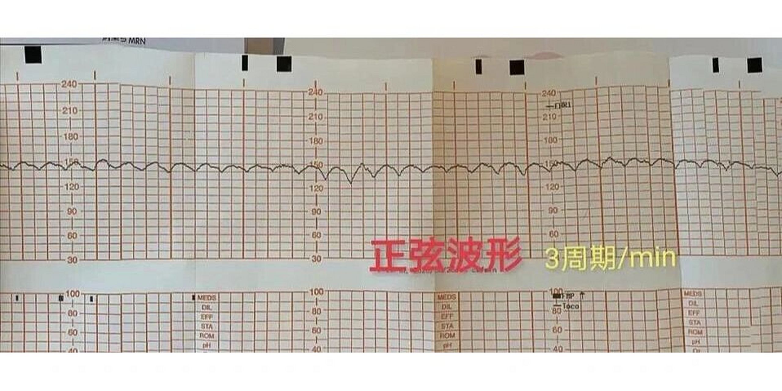 正弦波胎监 马上住院!