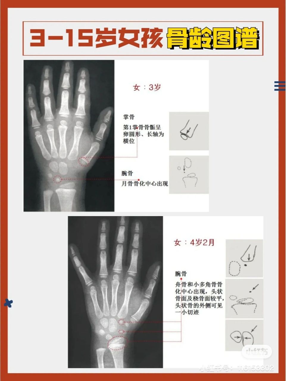 骨龄闭合图对比图片