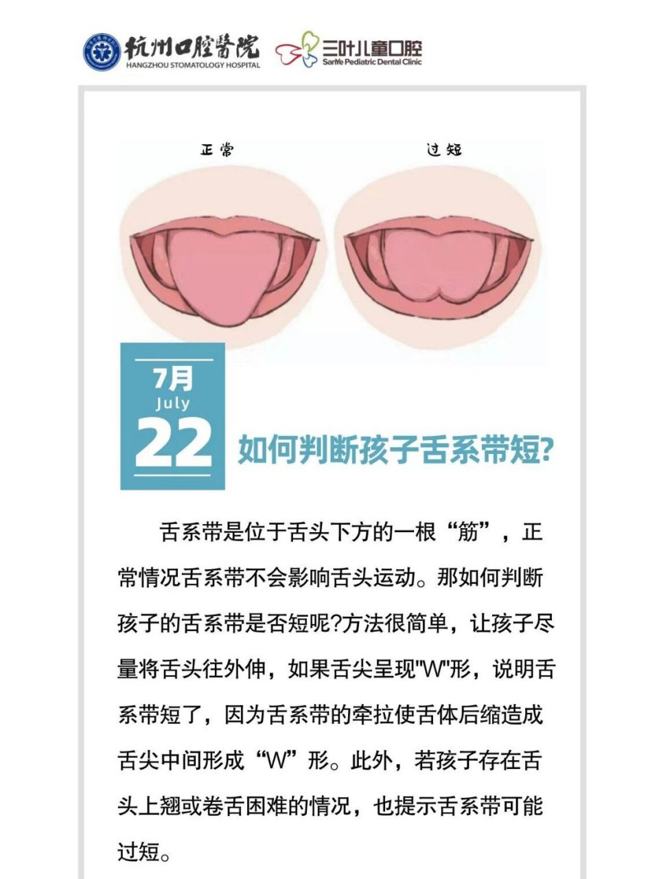 舌系带是位于舌头下方的一根"筋",正常情况舌系带不会影响舌头运动.