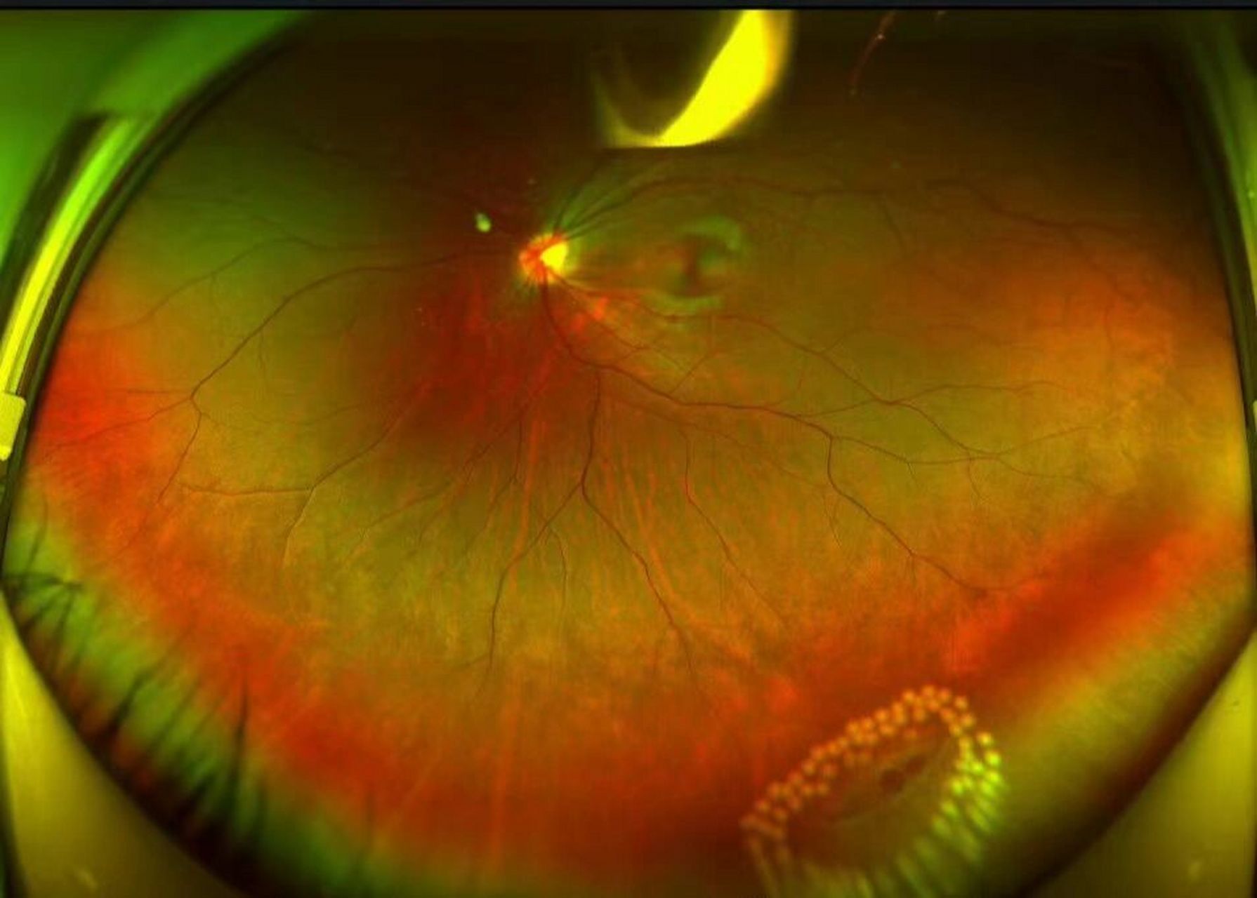 (图为眼底照) 低度近视人群也是会有视网膜裂孔问题的,视网膜裂孔并不