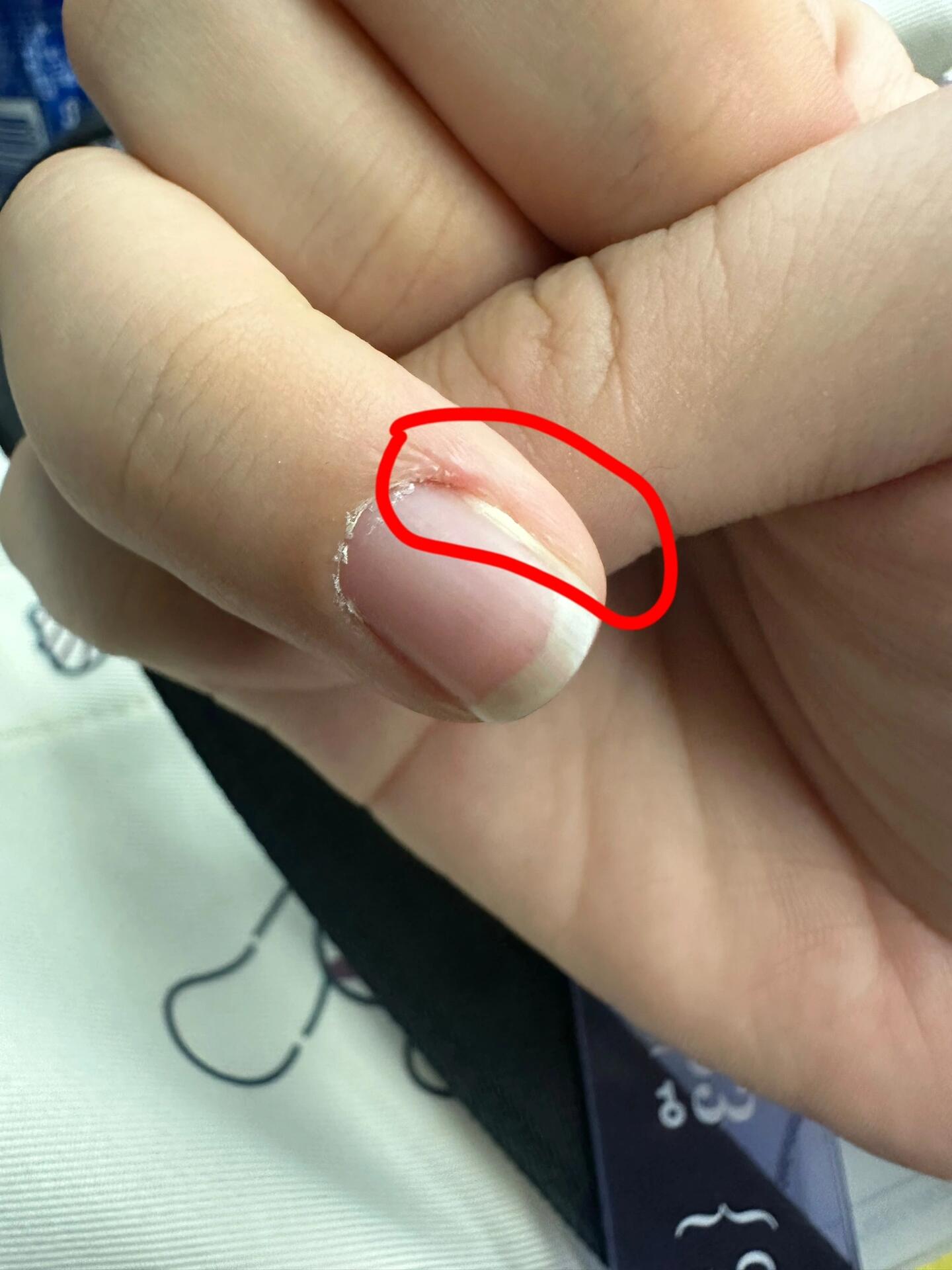 有没有人的指甲是从侧边分离的