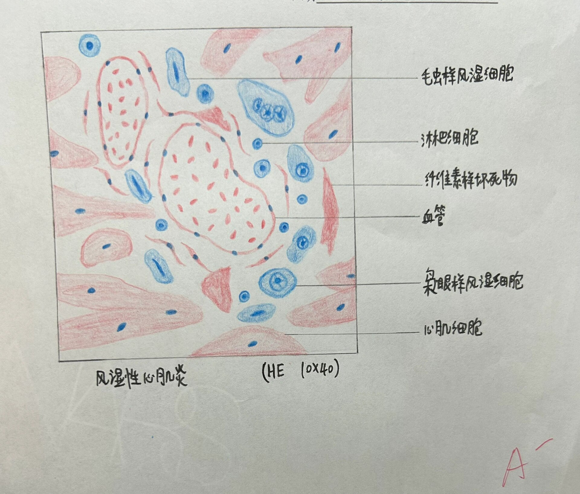 慢性肾小球肾炎手绘图图片