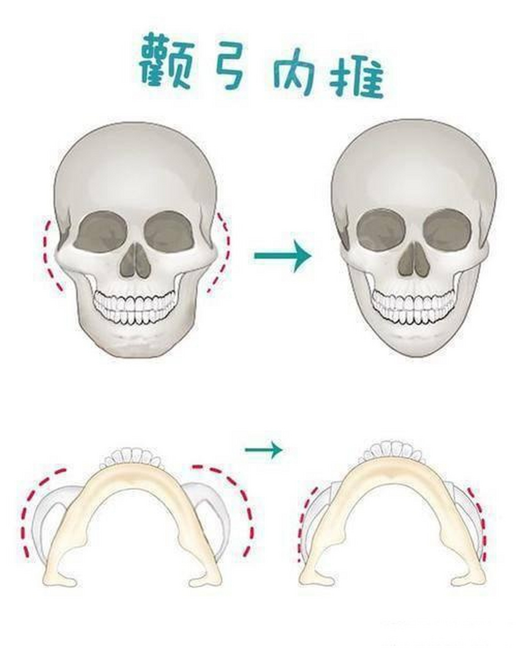 颧骨内推是什么原理图片